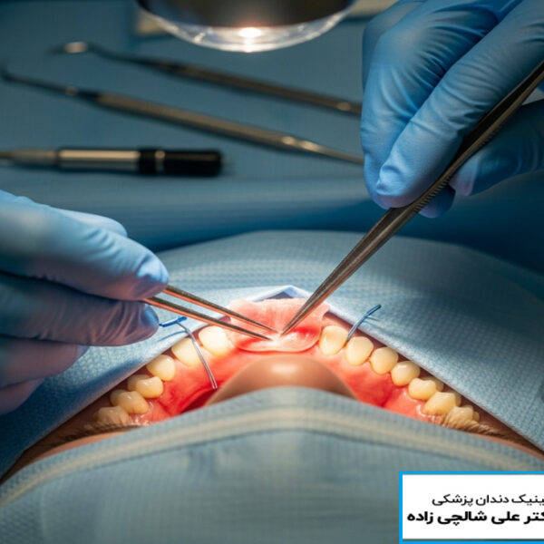 تصویر حراحی لثه حراحی لثه