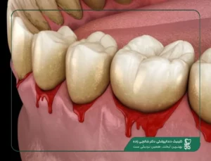 عفونت ایمپلنت
