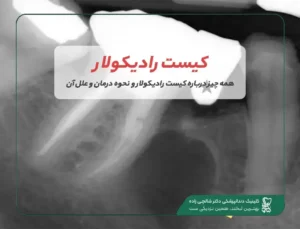 رادیکولار