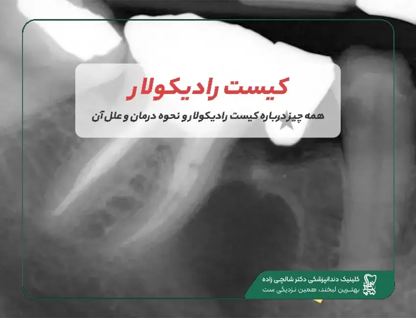 رادیکولار