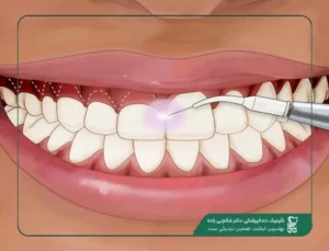 جراحی لثه در قیطریه