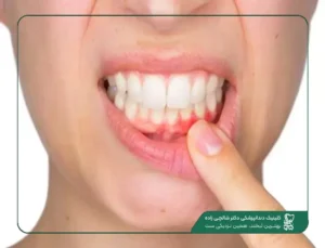 قارچ لثه