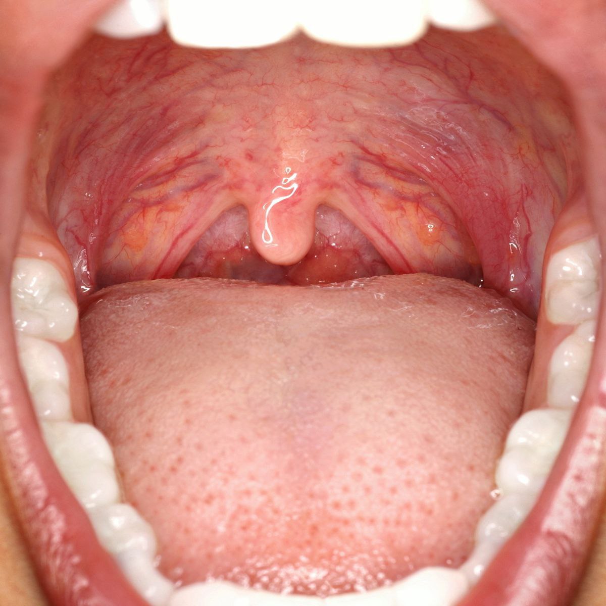 روش هایی برای درمان خشکی دهان
