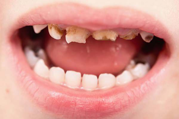 چگونه مینای دندان خود را تقویت کنیم؟