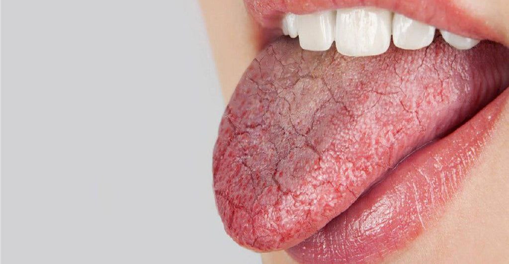 علت  احساس خشکی دهان چیست؟