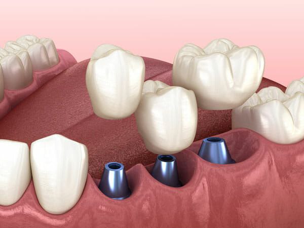 مزایای کاشت دندان چیست؟