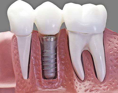 آیا میدانید عوارض ایمپلنت دندان چیست؟