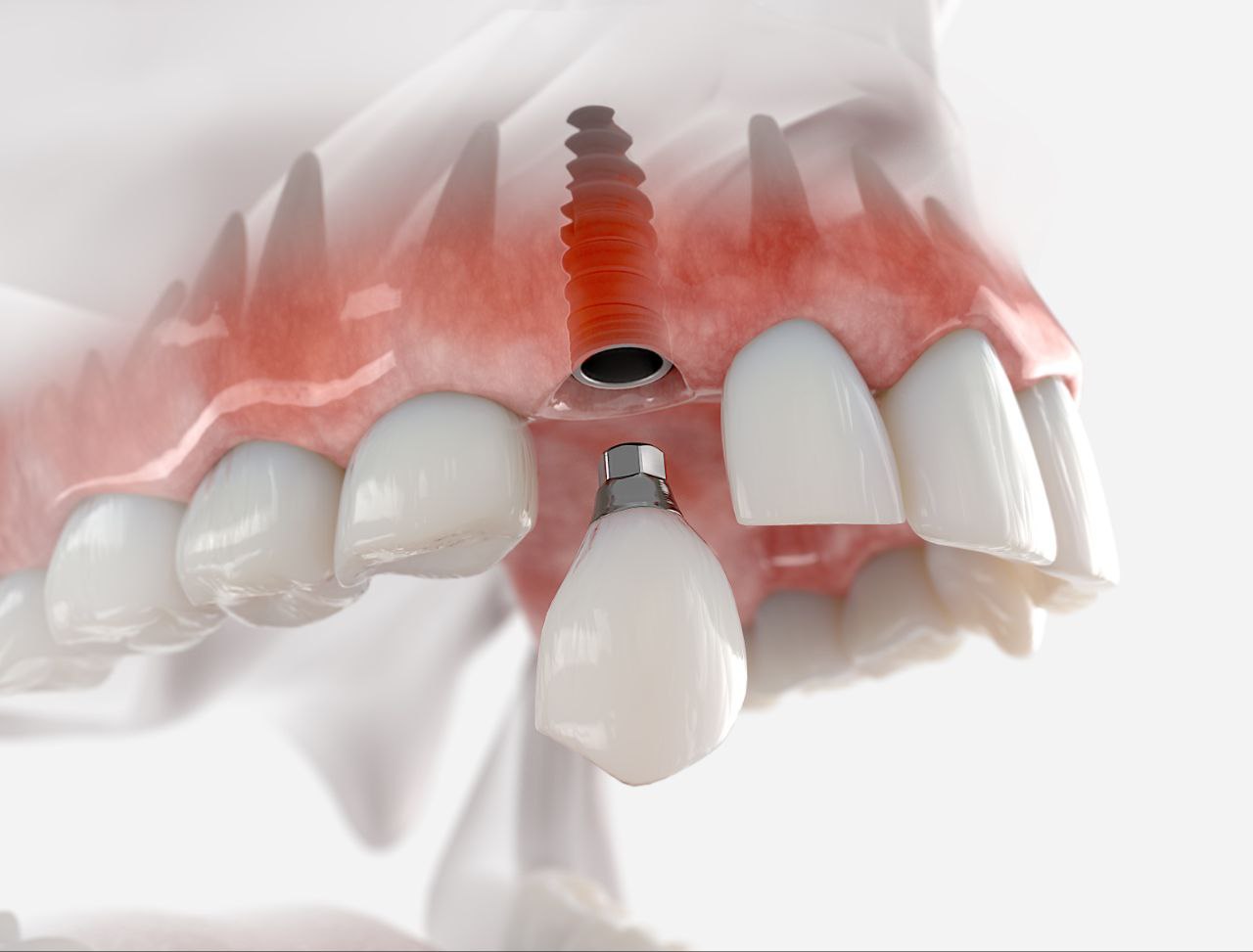 چگونه باید از ایمپلنت های دندانی مراقبت کنیم؟