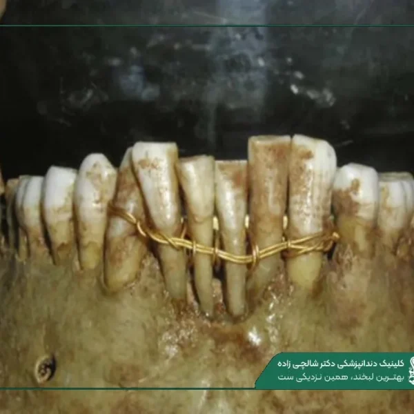 IMG_20250812_201242_001 (2) (2) تاریخچه ایمپلنت