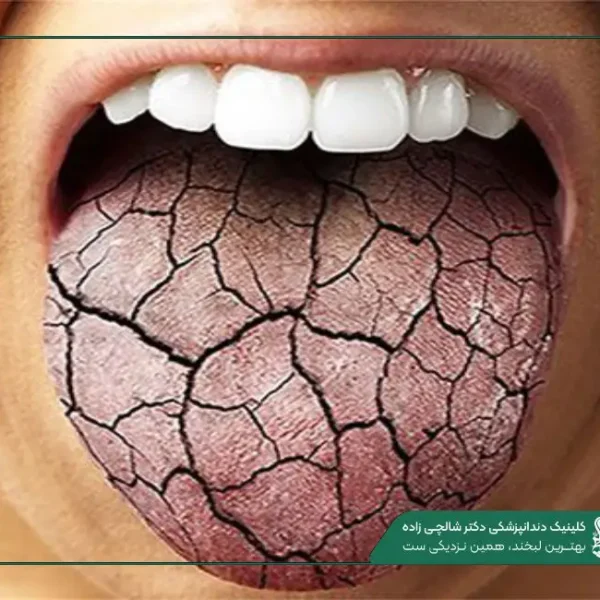 IMG_20250812_201242_001 (2) (60) خشکی دهان