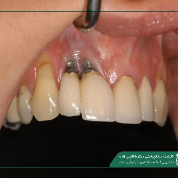 New Project (5) علائم عفونت دندان