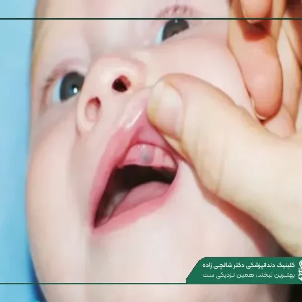 IMG_20250812_201242_001 (2) (16) علت سیاهی لثه در کودکان