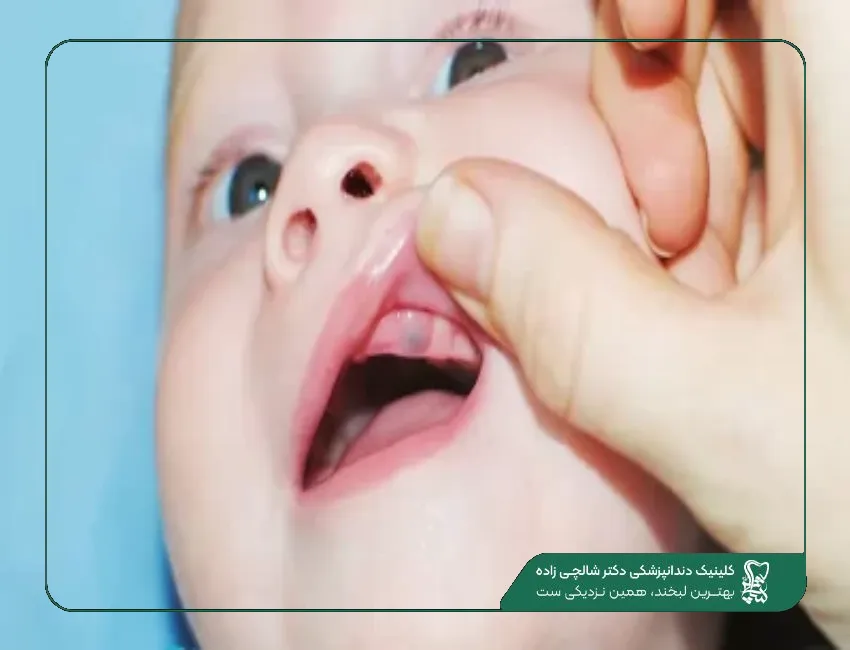 علت سیاهی لثه در کودکان
