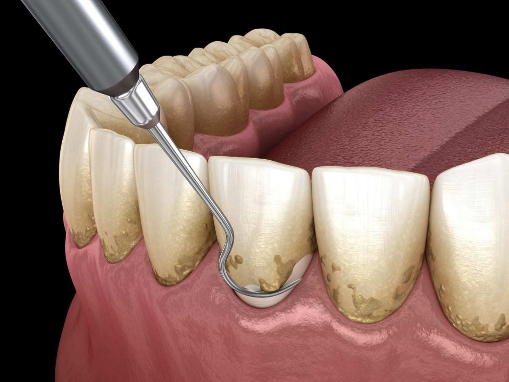 جرم گیری دندان ضرر دارید؟ | جرم گیری دندان چه عوارضی دارد؟