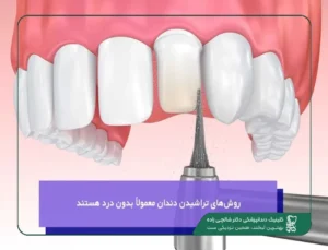 مقدار تراش دندان برای لمینت