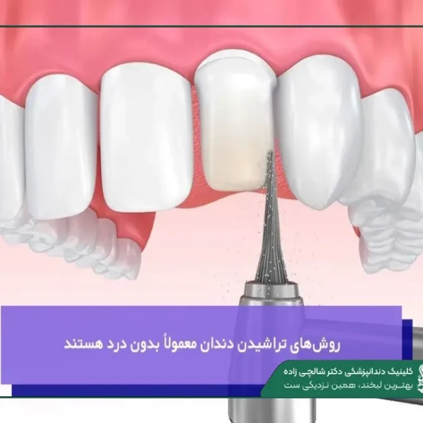 IMG_20250812_201242_001 (2) (41) مقدار تراش دندان برای لمینت