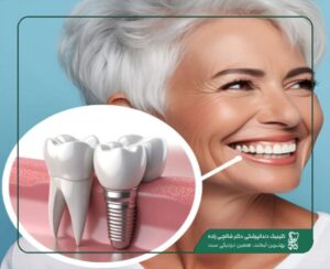 سن مناسب برای ایمپلنت