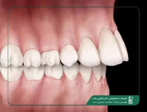 عقب رفتن لثه