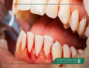 خونریزی لثه