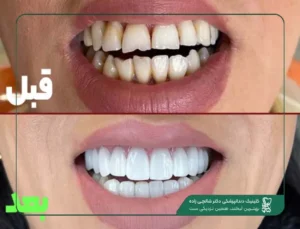 لیفت لثه