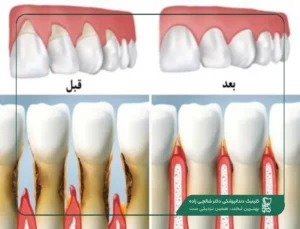 پیوند لثه
