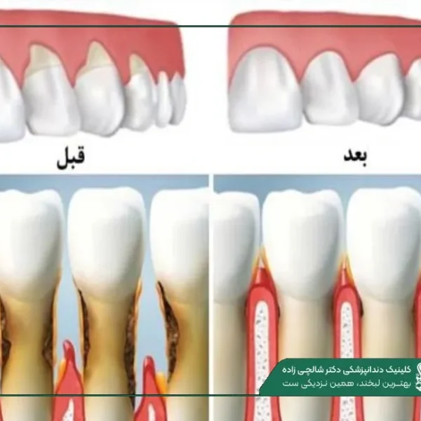 IMG_20250812_201242_001 (2) (14) پیوند لثه