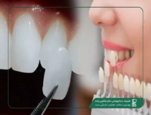 لمینت دندان در قیطریه