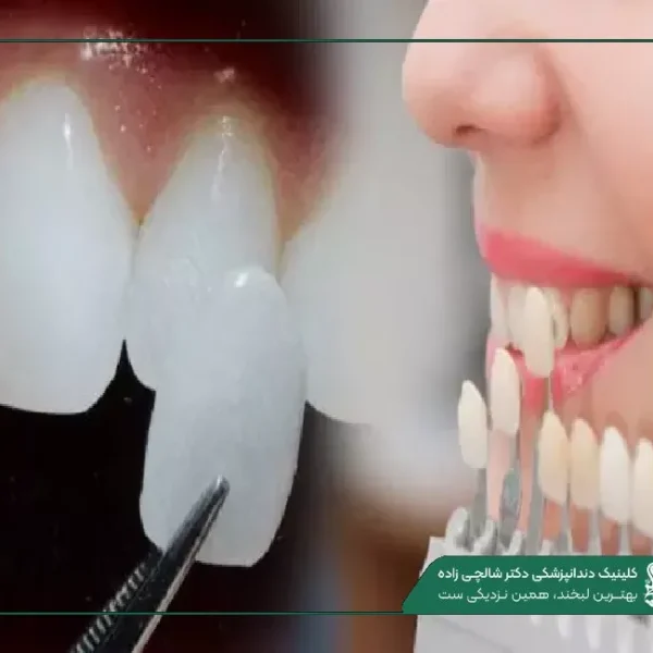 New Project (11) لمینت دندان در قیطریه