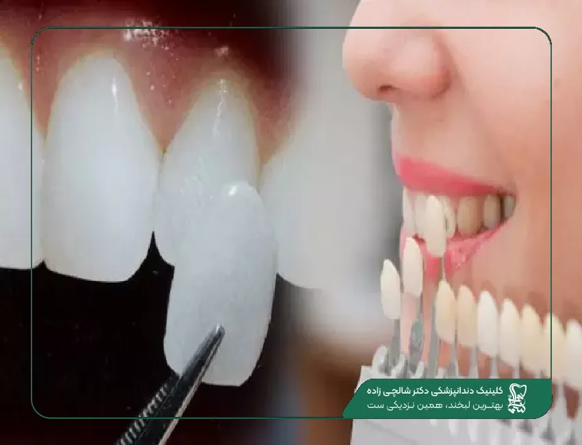لمینت دندان در قیطریه