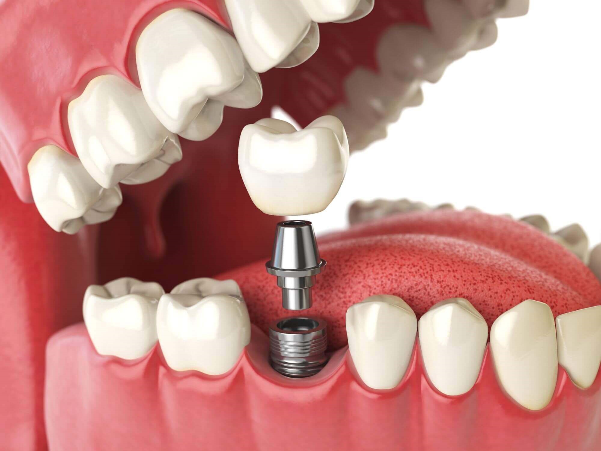 Risks of implants for the gums