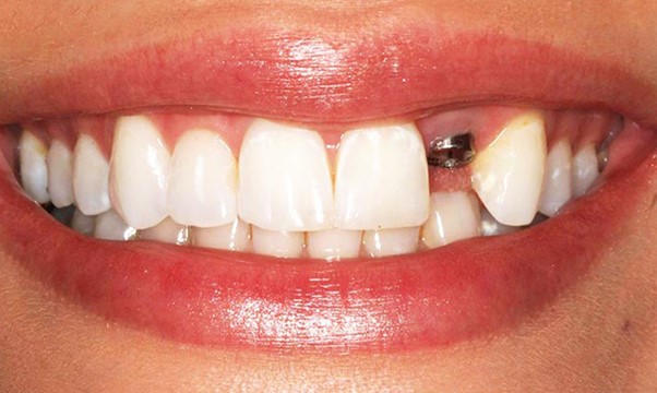 بیماری استخوان چه تاثیری بر سلامت دهان و دندان شما می گذارد؟