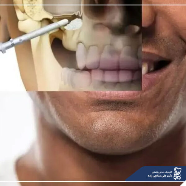جراحی سینوس لیفت جراحی سینوس لیفت