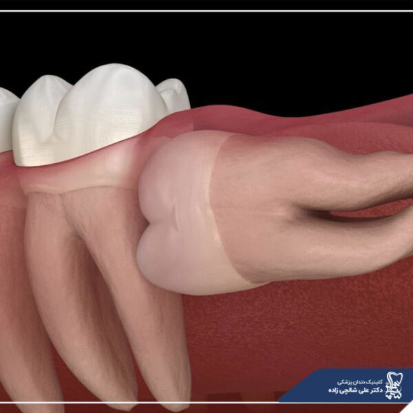 جراحی دندان نهفته جراحی دندان نهفته