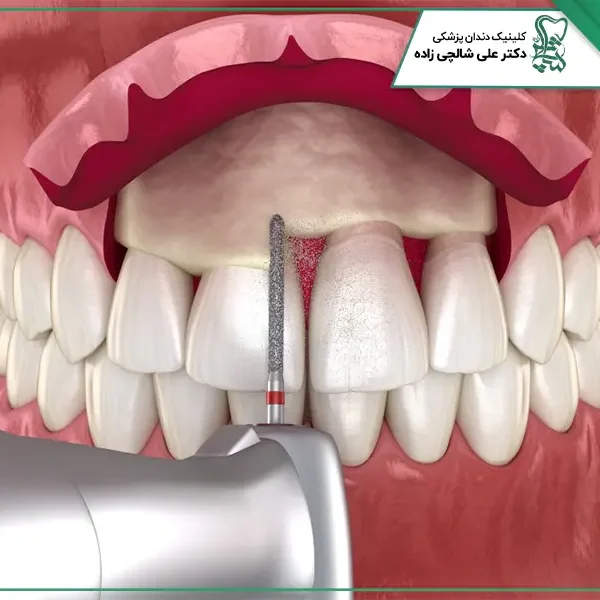 جراحی افزایش طول تاج دندان جراحی افزایش طول تاج دندان