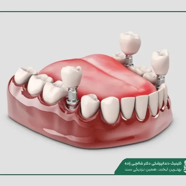 New Project (1) ایمپلنت دندان