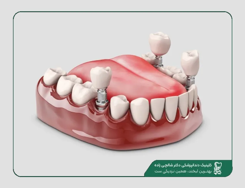 ایمپلنت دندان