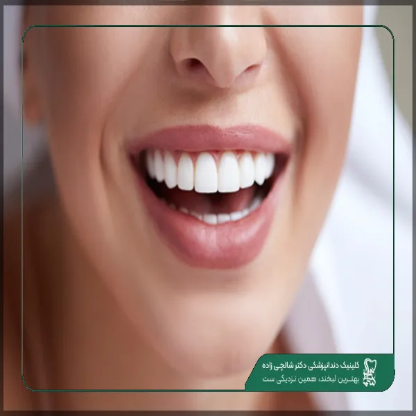care-after-gum-surgery (1) هزینه ونیر کامپوزیت دندان و بلیچینگ در چیذر