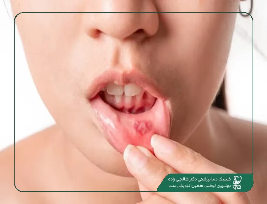 آفت دهان کودک