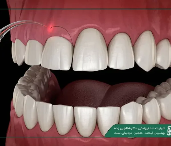 Laser-Gum-Conturing-768x512 جراحی لثه با لیزر