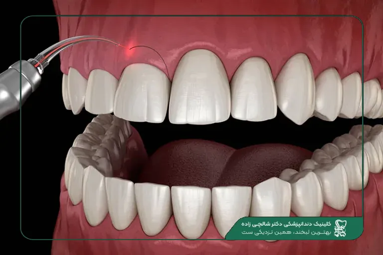 جراحی لثه با لیزر