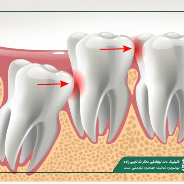 New Project (15) جراحی دندان عقل نهفته