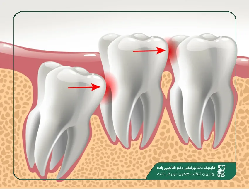 جراحی دندان عقل نهفته