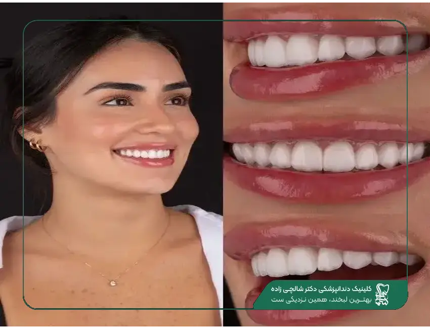 لمینت سرامیکی یا کامپوزیتی