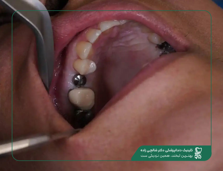 ایمپلنت بدون جراحی و درد
